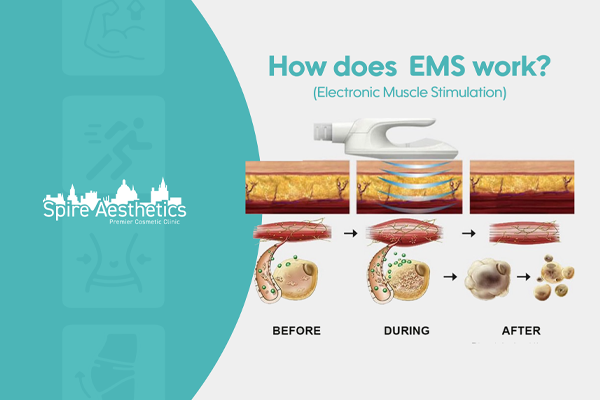 EMS treatment for post pregnancy weight loss treatment Brentwood