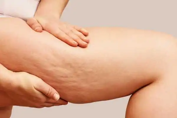 Image of woman showing leg with cellulite Brentwood