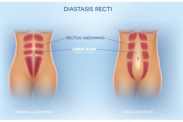 What Non-Surgical Options Are Available for Diastasis Recti Brentwood?