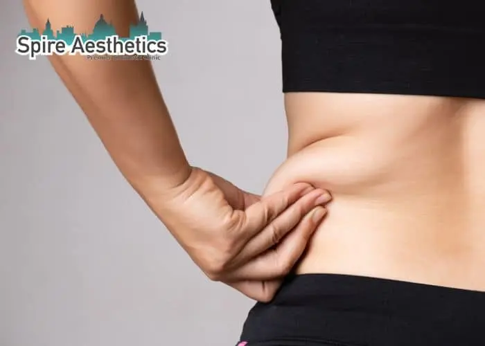 Image of woman pinching fat on their hips Brentwood. Fat Freezing treatment