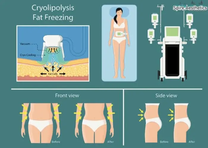 Fat freezing treatment Brentwood benefits for competitions to remove stubborn fat deposits.