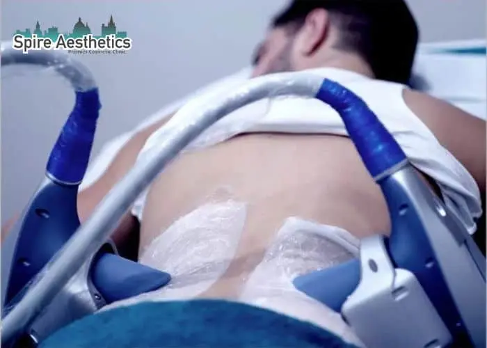 Man having fat freezing treatment done on love handles before a competitions Brentwood to create a sculpted look.
