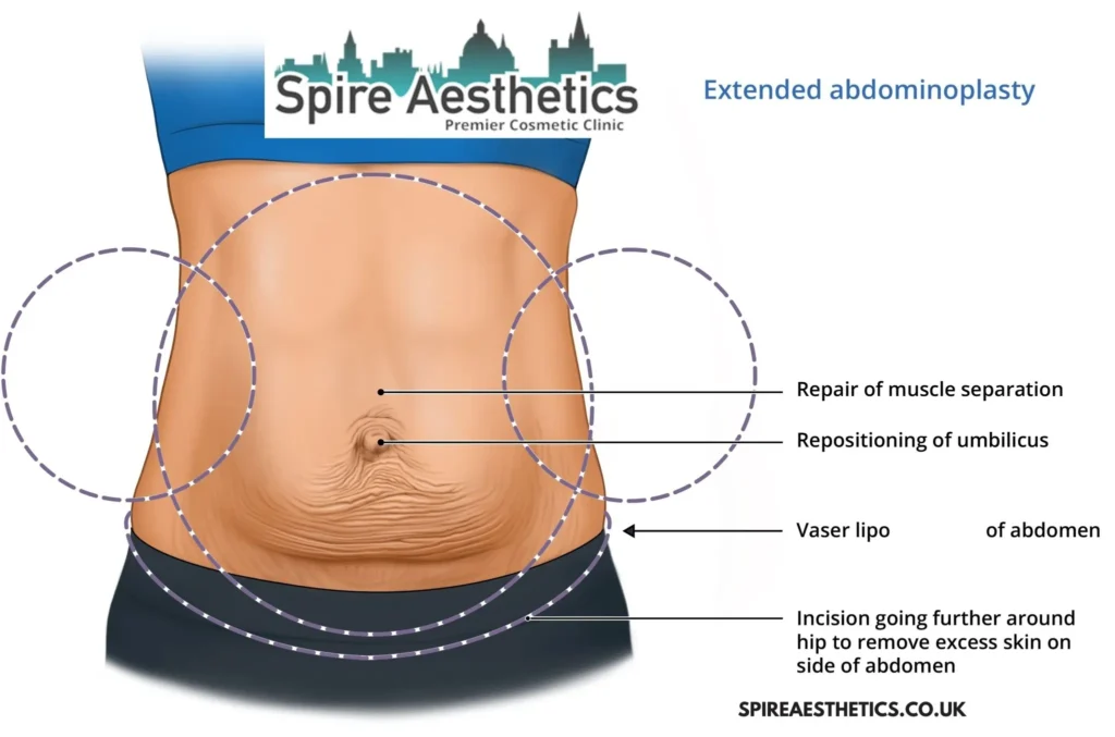 Understanding Loose Skin After Gastric Band Brentwood Surgery and HIFU Treatment
