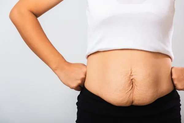 Image of a woman's stomach after weight loss with sagging skin following a gastric band Brentwood