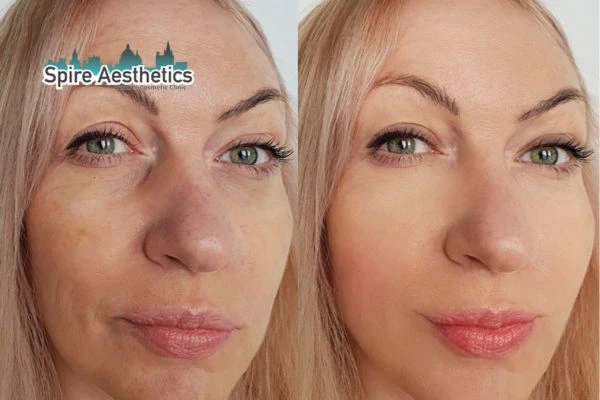 Morpheus8 Treatment Brentwood Before & After Results