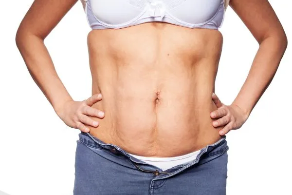 sagging skin on woman's stomach after weight loss injections Brentwood