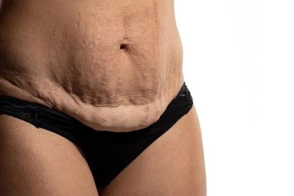 Image of womans stomach after weight loss injections Brentwood showing saggy skin