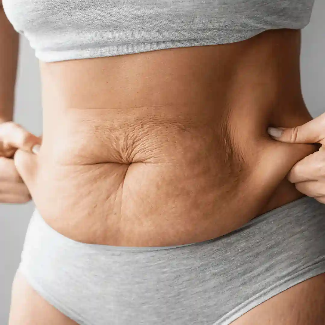 Is It Normal to Have Loose Skin After Pregnancy Brentwood?