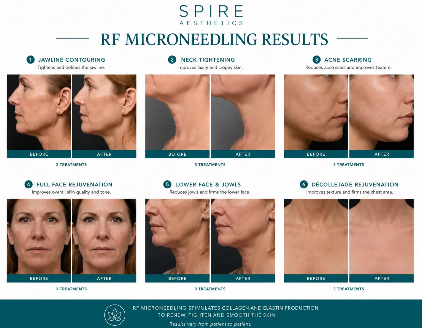 RF Microneedling Skin tightening Brentwood results