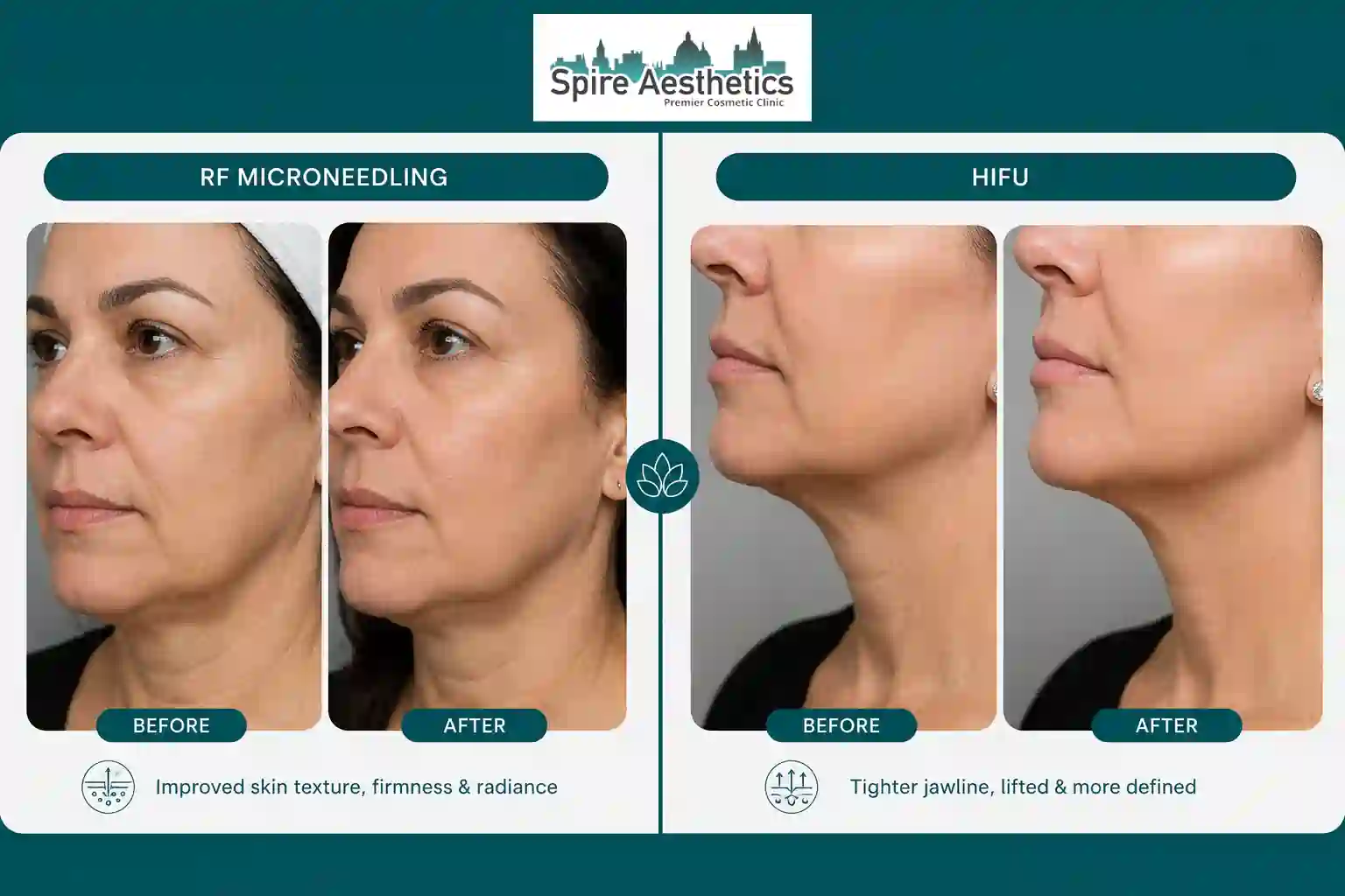 Can RF Microneedling and HIFU Be Combined Brentwood?