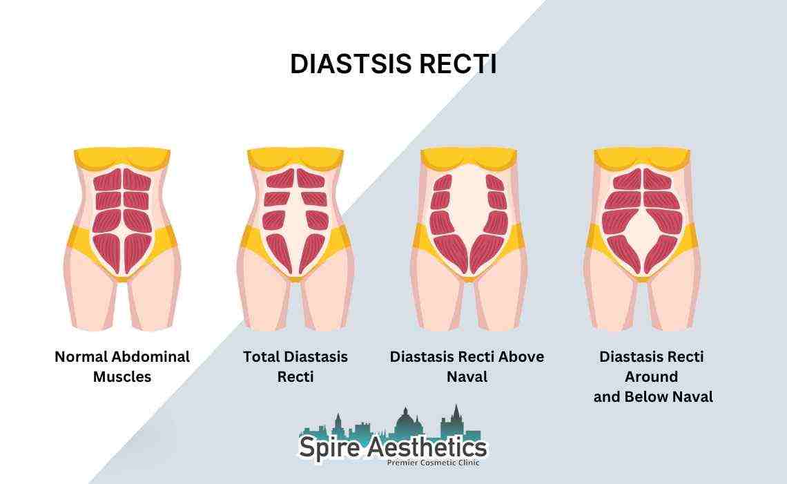 Is Non-Surgical Diastasis Recti Treatment Right for You? Common Concerns Answered Brentwood